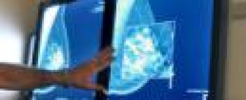 American Cancer Society says start mammograms at 45, not 40